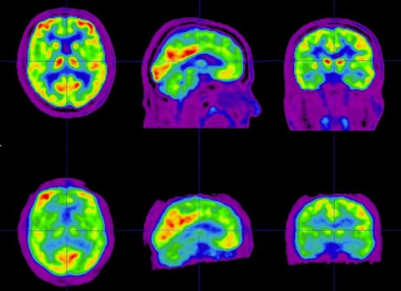 Switzerland advances personalized Alzheimer’s therapy
