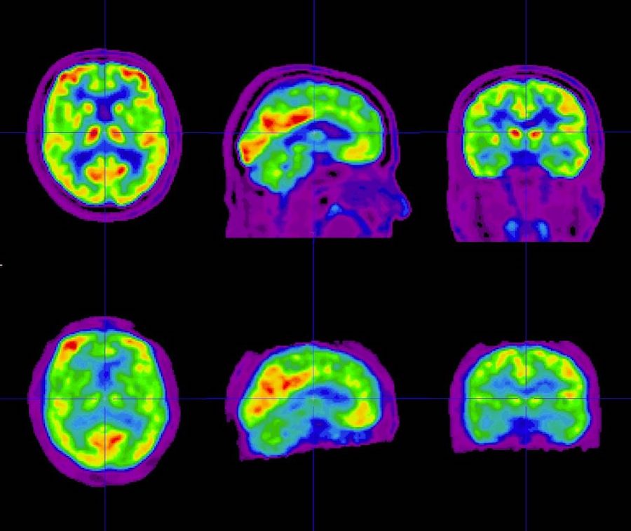 Switzerland advances personalized Alzheimer’s therapy